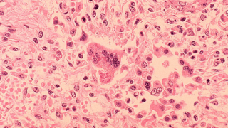 Visual representation of measles risks and recent outbreaks in Cook County